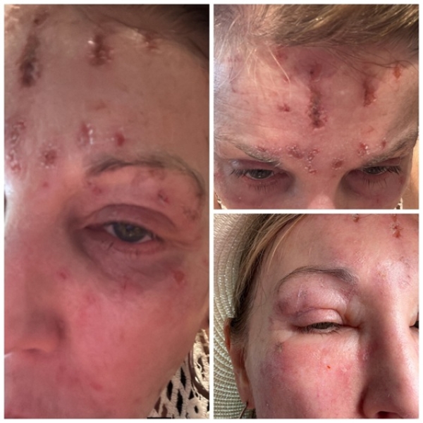 Extranjera se somete a tratamiento estético en clínica privada de Puerto Vallarta y resulta con graves quemaduras en su rostro